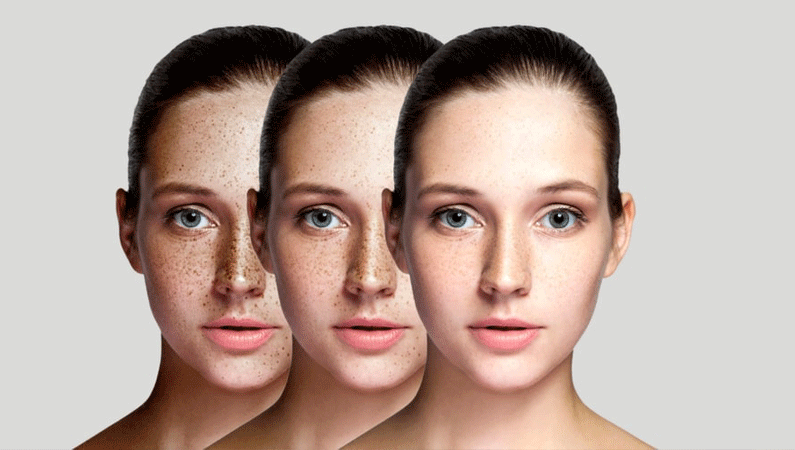 Pigmentation Therapy